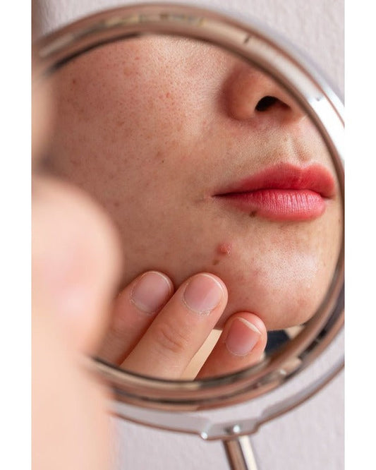 Aknė ir hormonai: ką svarbu žinoti