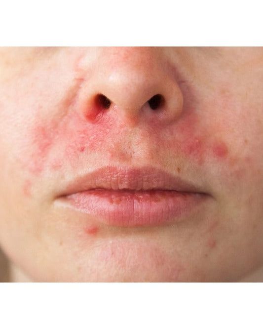 Perioralinis dermatitas: priežastys ir simptomai