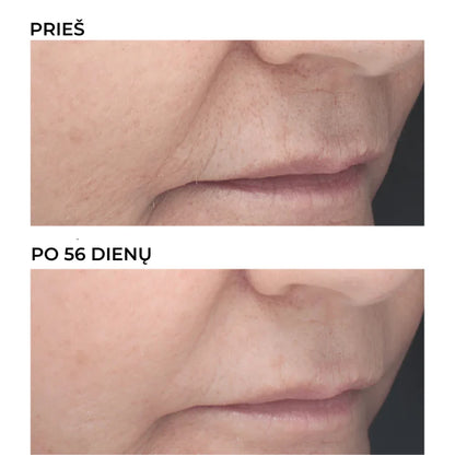 RETINAL Retinoidų naktinis koncentratas 6 %, raukšlių mažinimui, rezultatas