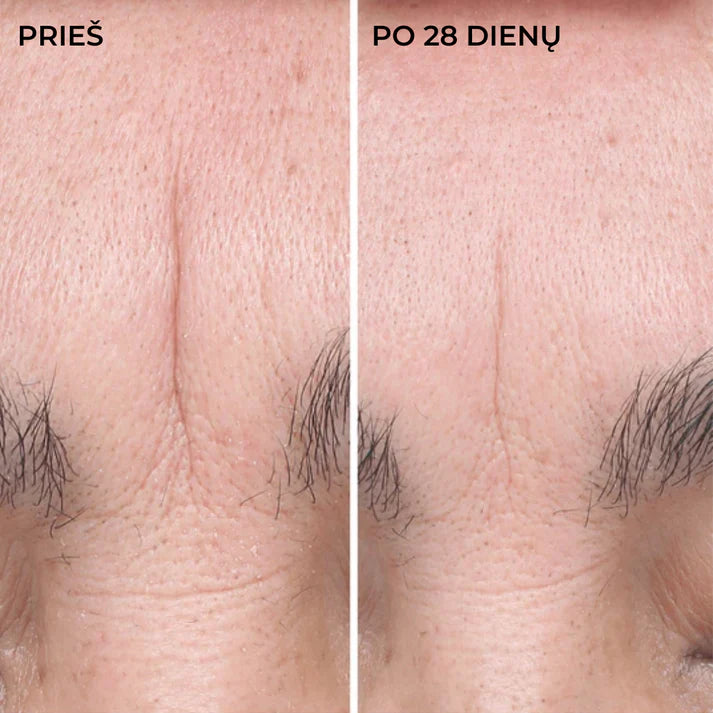 DERMEDEN HYAL FILLER serumas, rezultatai