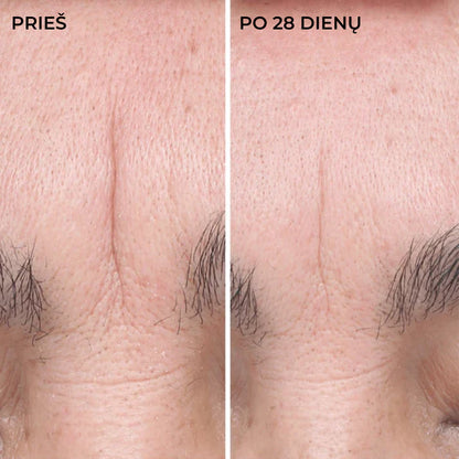 DERMEDEN HYAL FILLER serumas, rezultatai